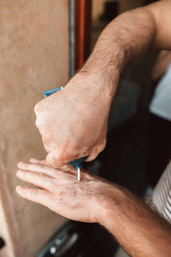 Quelle est la meilleure approche pour traiter une peau sujette à la dermatite séborrhéique?
